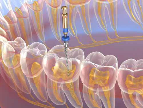 Dental Treatment Image