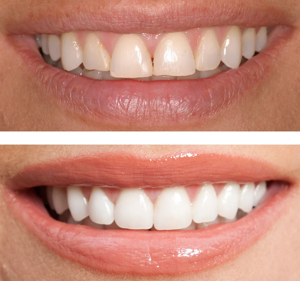 Teeth Whitening Treatment