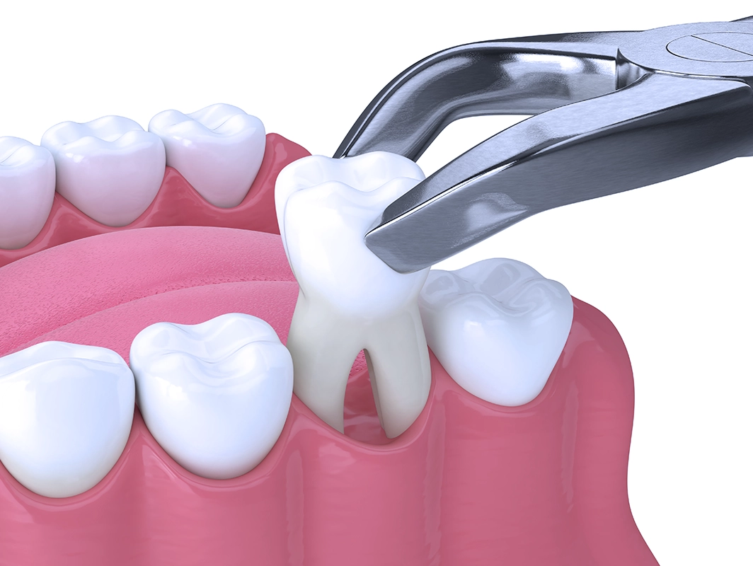 Teeth Whitening Treatment